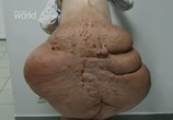 Сцена из фильма Discovery: Радикальная хирургия. Опухоль весом 72 килограмма / Super Surgery. 72 Kilo Tumour (2004) 